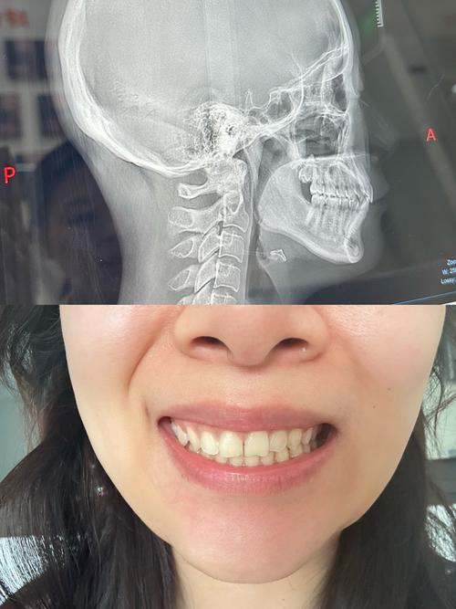 牙齿片切矫正效果图效果自然吗？会损伤牙齿吗？-图3