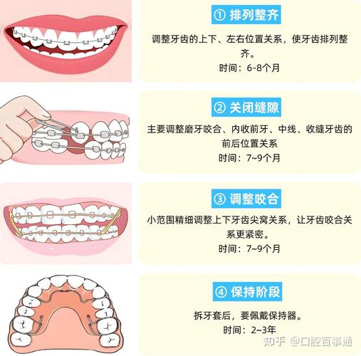 牙套矫正牙齿的原理-图2