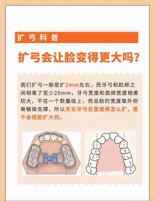 扩弓矫正牙齿矫正有哪些潜在危害？-图1