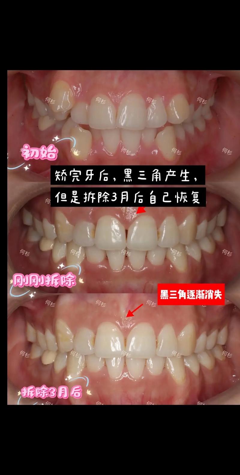 牙齿矫正黑三角图片-图1