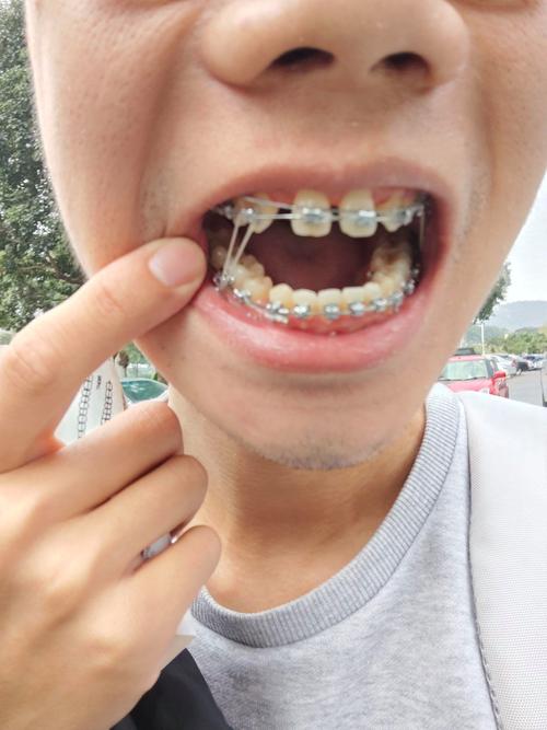 22岁能矫正牙齿吗-图3 22岁能矫正牙齿吗-图3