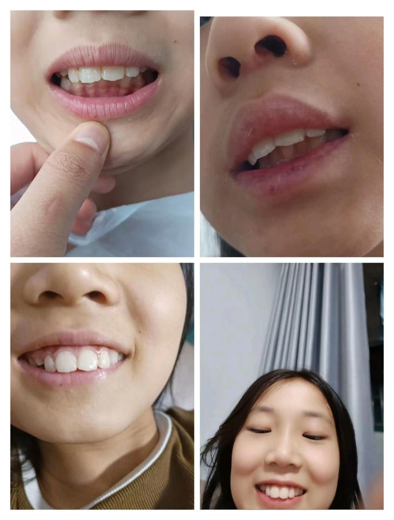 30岁矫正牙齿,后悔的原因究竟是什么?-图3 30岁矫正牙齿,后悔的原因究竟是什么?-图3