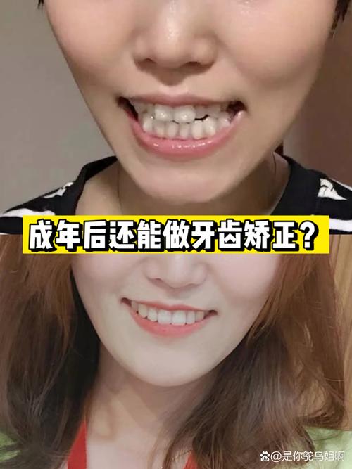 成人还能牙齿矫正吗-图2