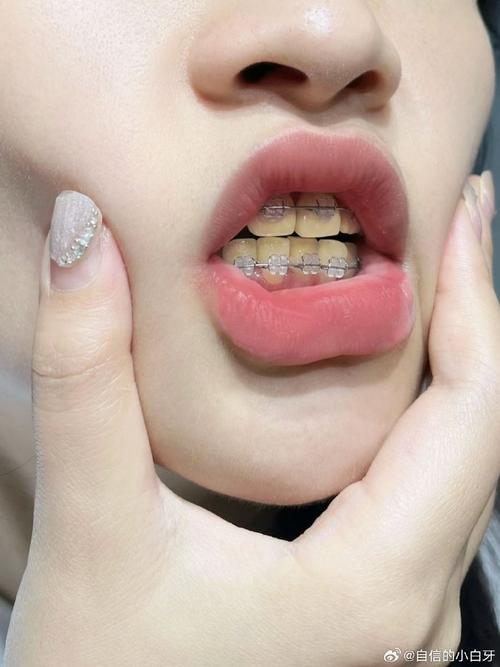 矫正牙齿后牙齿变黄-图1