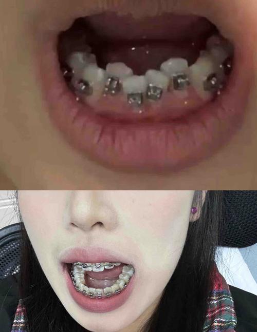 矫正牙齿后牙齿变黄-图2