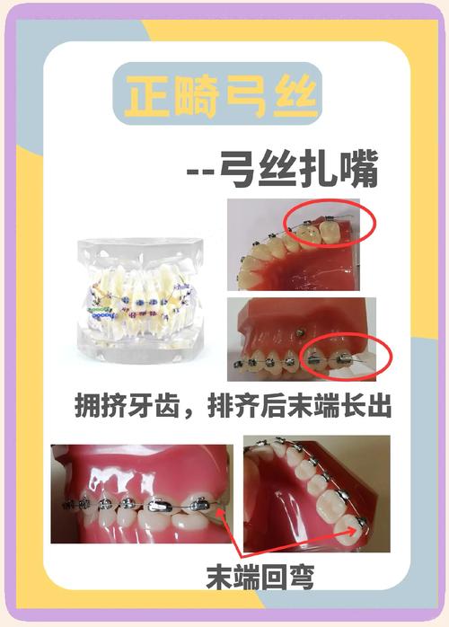 钢丝矫正牙齿的原理是什么？如何让牙齿一步步移动变整齐？-图2
