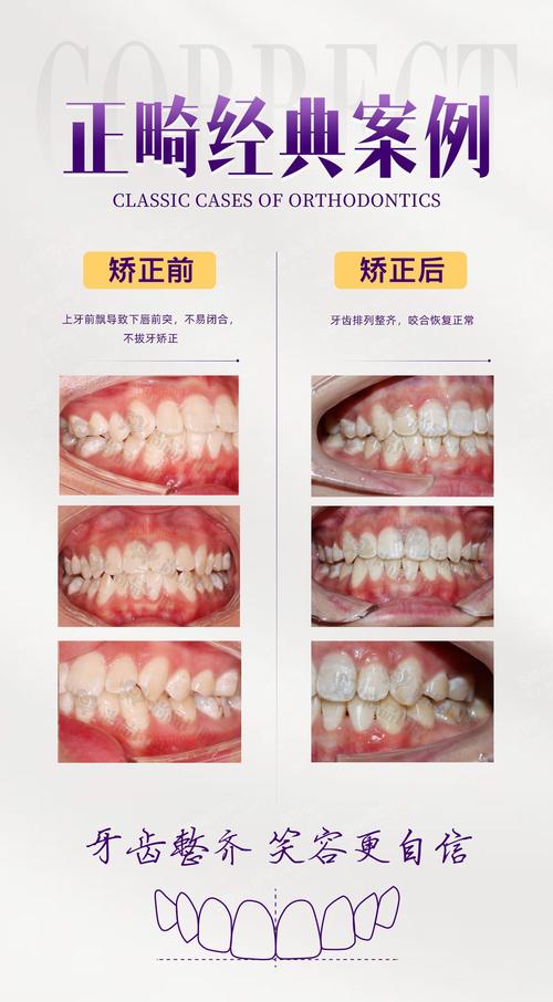 矫正牙齿不拔牙可行吗?会有哪些影响?-图3 矫正牙齿不拔牙可行吗?会有哪些影响?-图3
