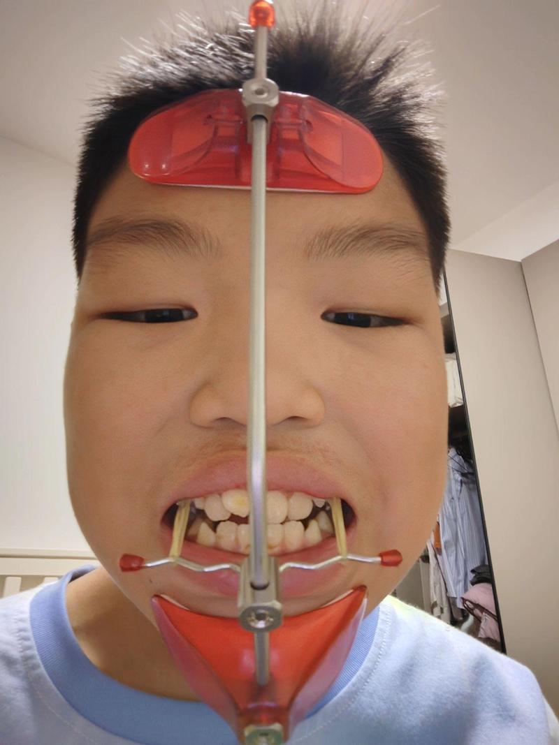 地包天牙齿矫正图片-图2