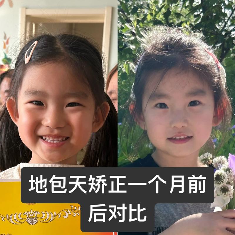 牙齿地包天能矫正吗？-图3