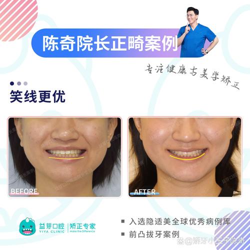 广州矫正牙齿哪家好？专业机构怎么选更靠谱？-图3