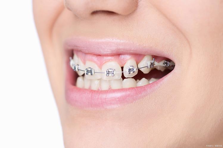 20岁可以矫正牙齿-图1