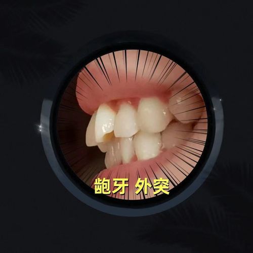 牙齿矫正透明牙套效果如何?舒适吗?-图2 牙齿矫正透明牙套效果如何?舒适吗?-图2
