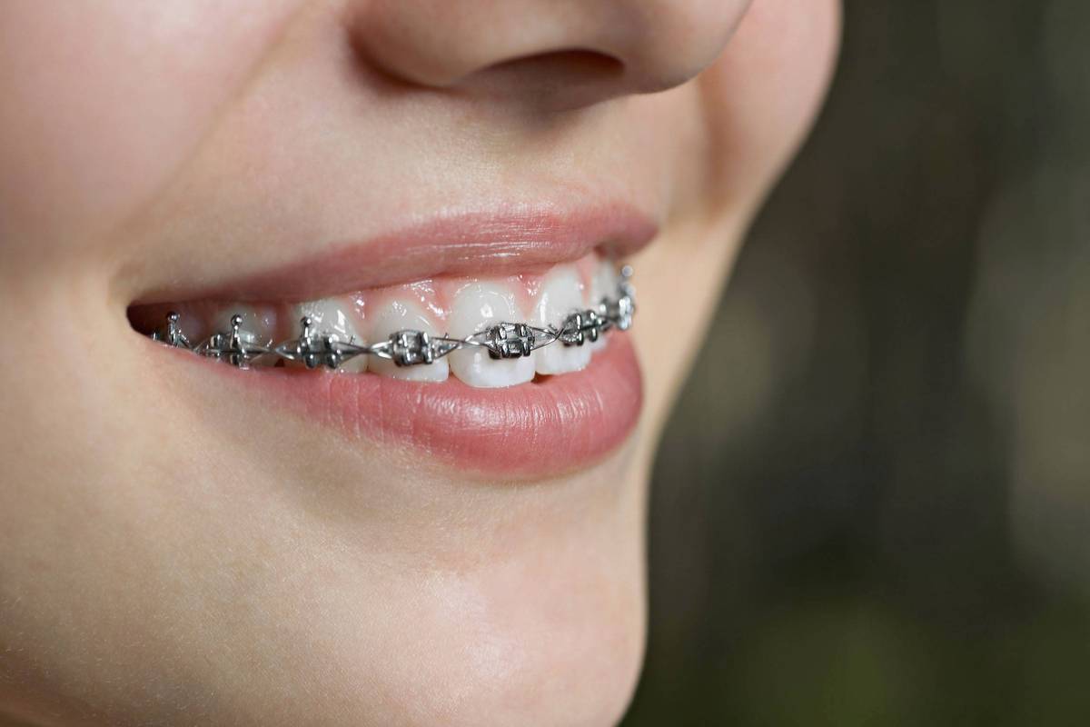 牙齿矫正全过程视频，矫正到底要经历哪些关键步骤？-图1