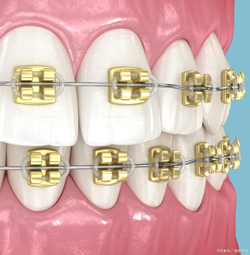 矫正牙齿带环图片-图2