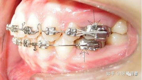 矫正牙齿带环图片-图3