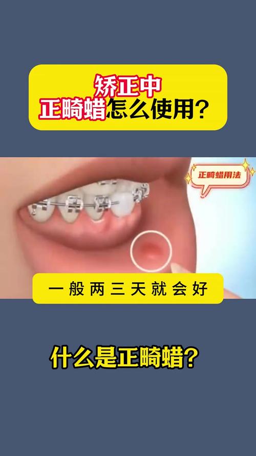 矫正牙齿钢丝刺到嘴，是什么原因？该如何处理？-图1