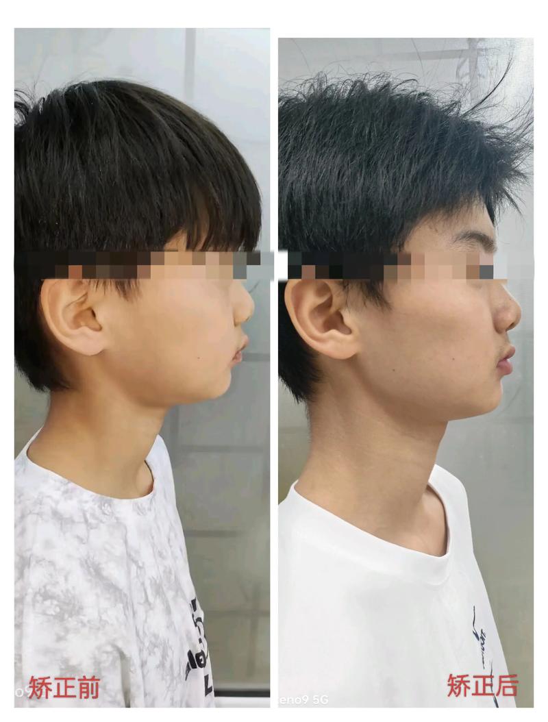 牙齿外突矫正会带来哪些危害？-图2