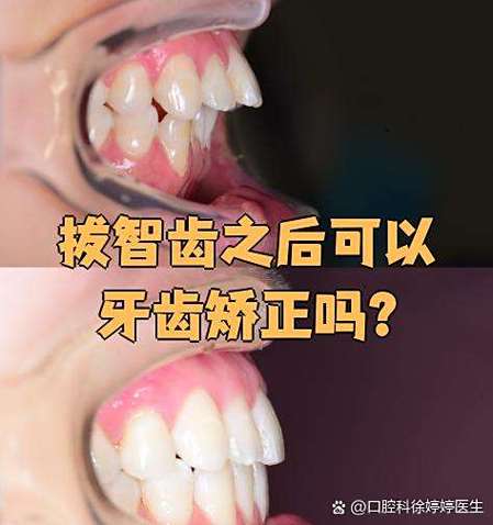 矫正中长智齿，会影响矫正效果吗？-图3