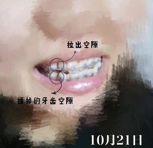 矫正牙齿弹簧弯了？该怎么办会影响矫正效果吗？-图1