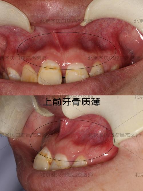 牙齿矫正会影响牙根位置吗？-图2