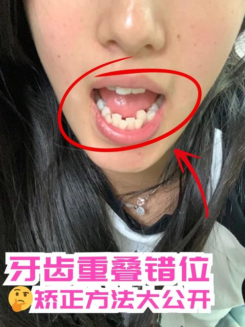 牙齿矫正会影响牙根位置吗？-图3