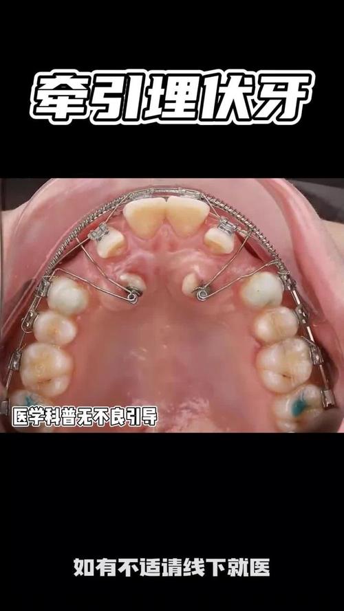 牙齿矫正颌间牵引-图1 牙齿矫正颌间牵引-图1