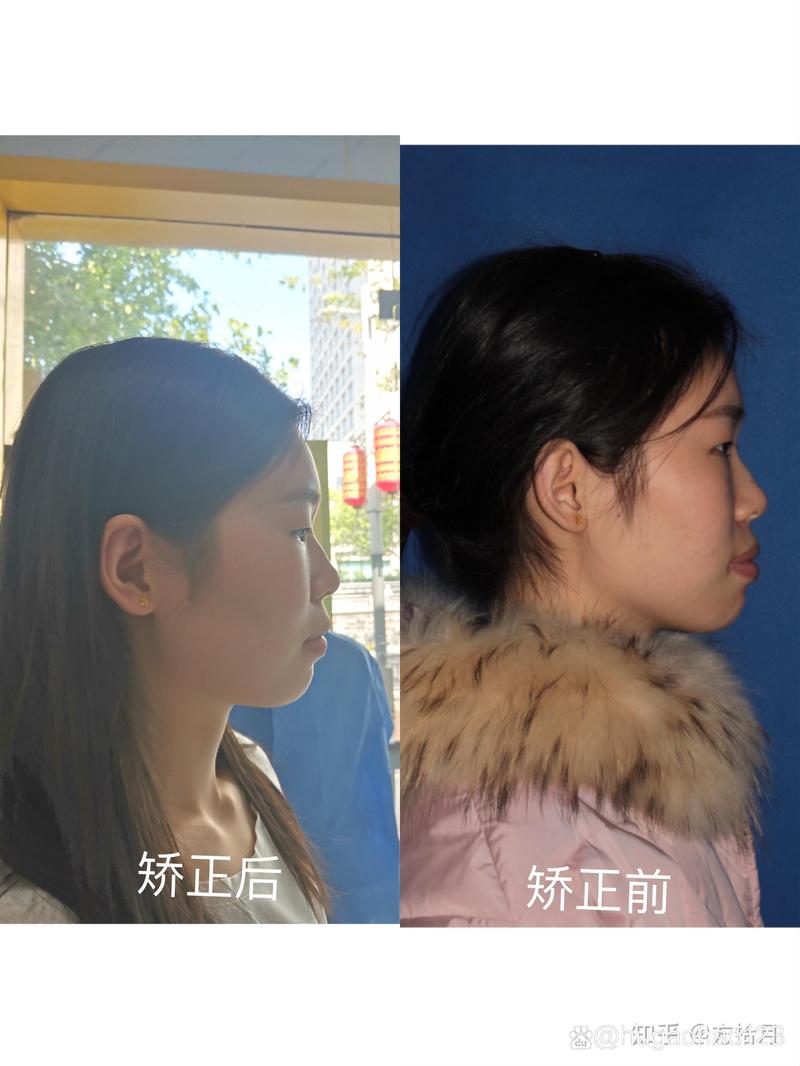 牙齿矫正图片侧面-图2