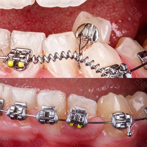 牙齿矫正加弹簧到底有啥用？-图2