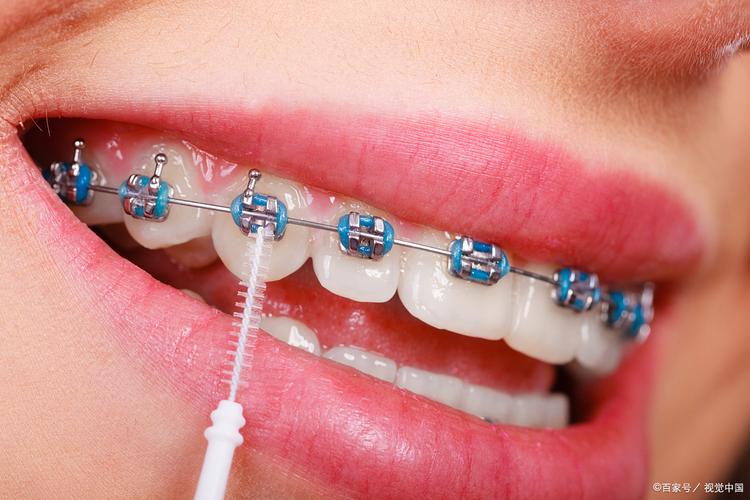 信阳成人牙齿矫正效果如何？要多久？费用多少？-图2