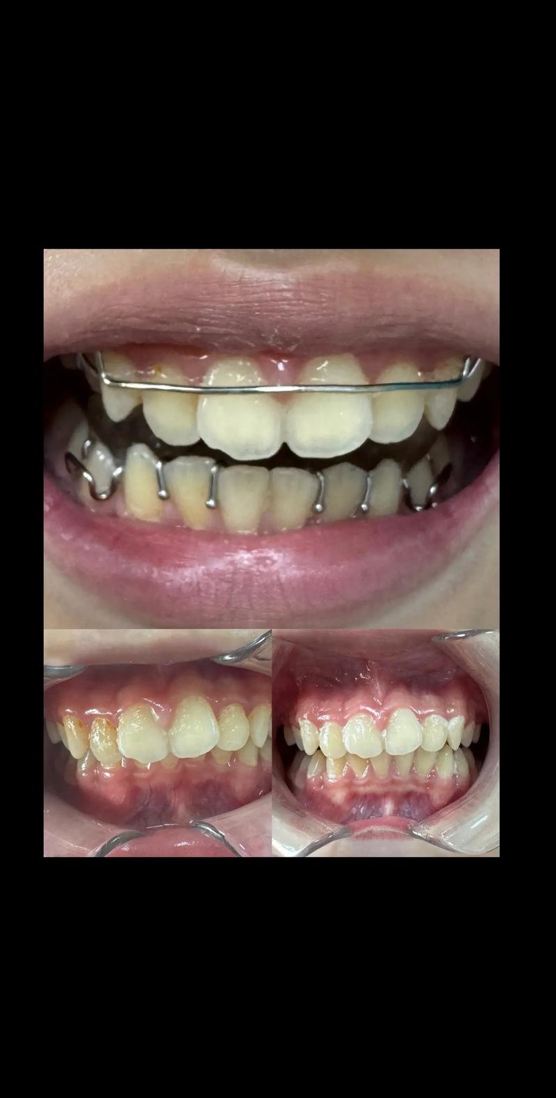 国外牙齿矫正效果真的比国内更好吗？差异在哪里？-图1