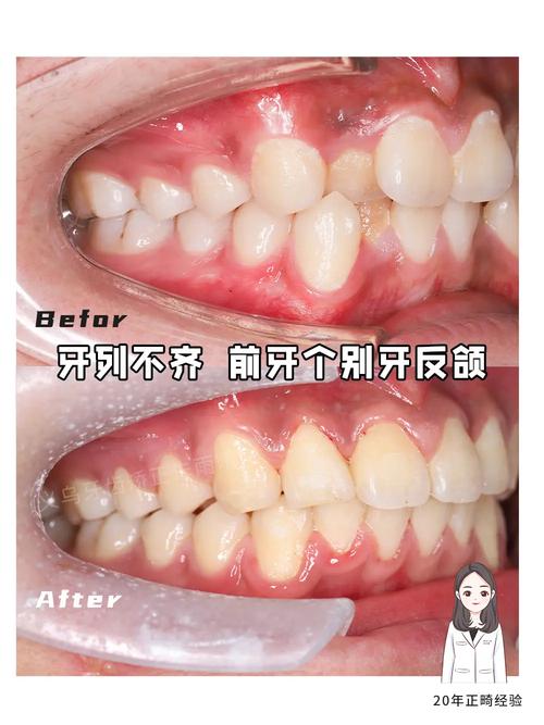 矫正牙齿前排不齐-图1