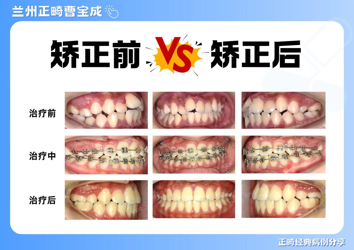 牙齿矫正最后不齐-图1