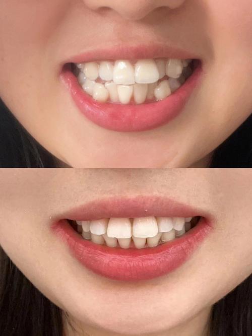 牙齿不齐选隐形矫正？效果与注意事项有哪些？-图2