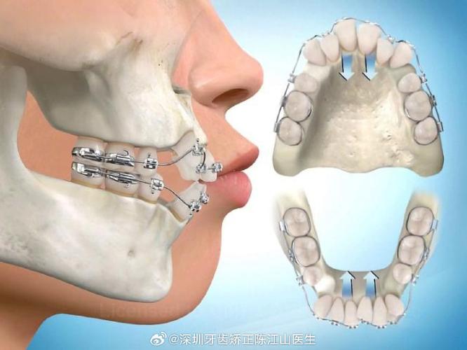 牙齿矫正拔牙？哪种情况必须拔？-图2