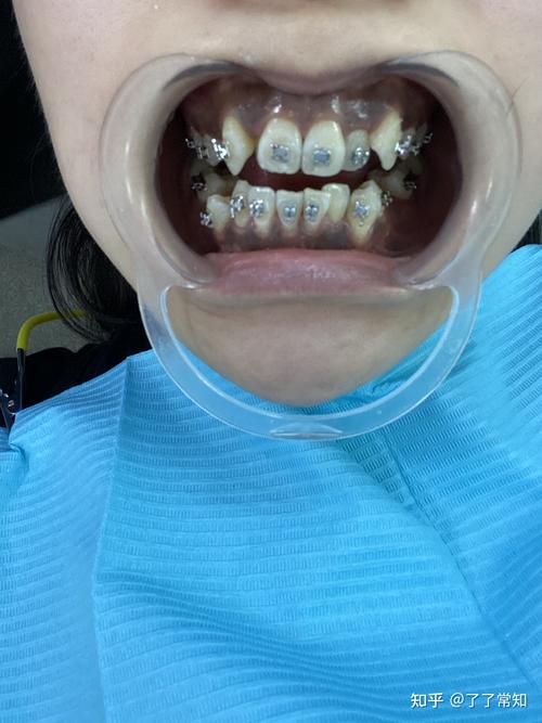 虎牙缺失牙齿矫正-图1