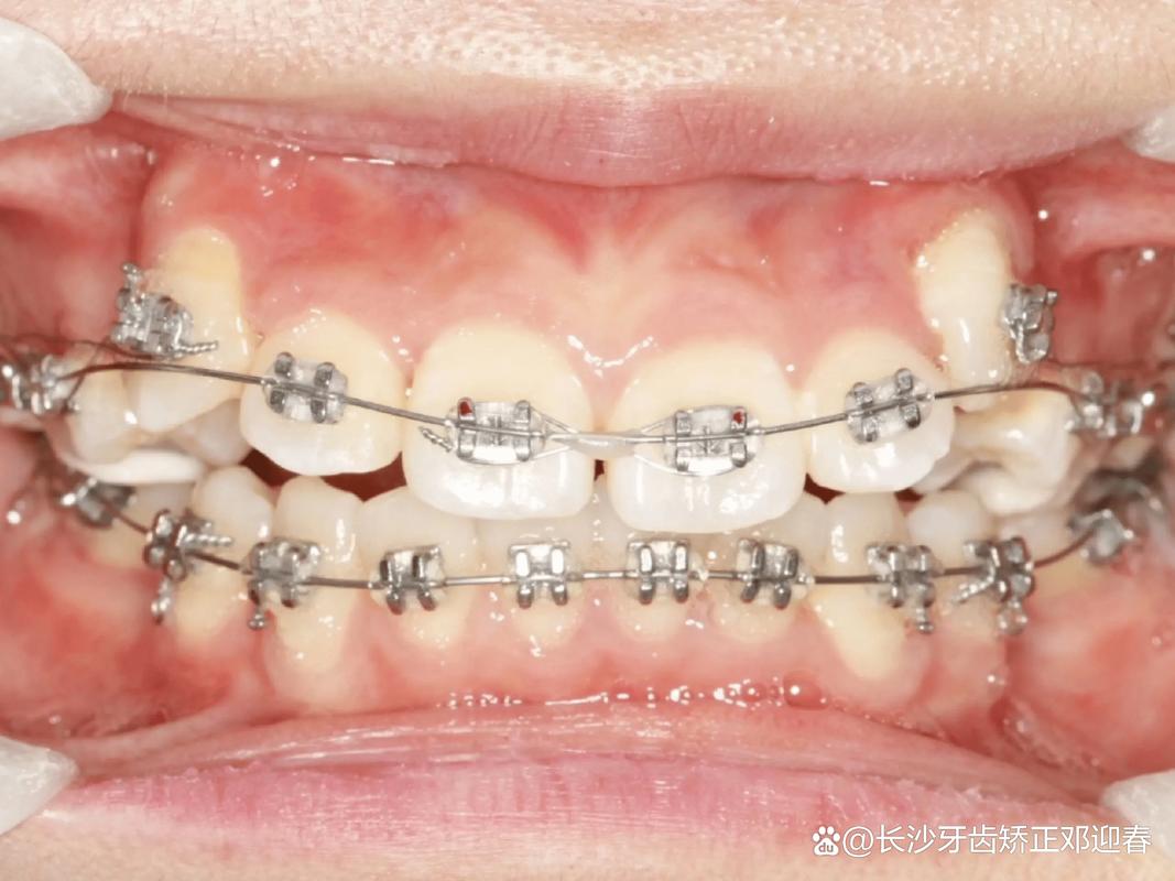 虎牙缺失牙齿矫正-图2