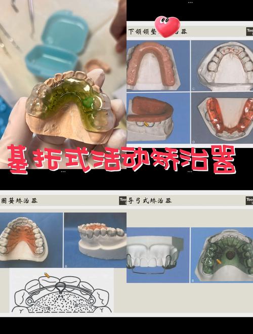 同步齿科牙齿矫正,有哪些独特优势值得关注?-图1 同步齿科牙齿矫正,有哪些独特优势值得关注?-图1