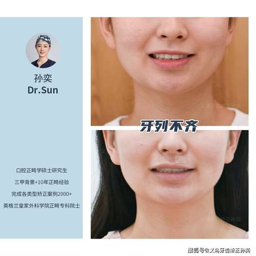 牙齿矫正不在中线-图1