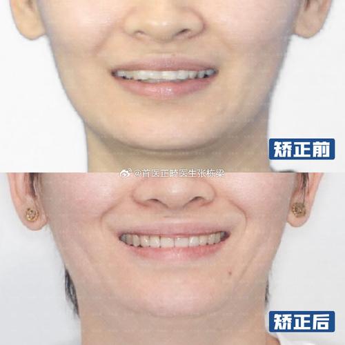 吴江矫正牙齿去哪里好?-图3 吴江矫正牙齿去哪里好?-图3