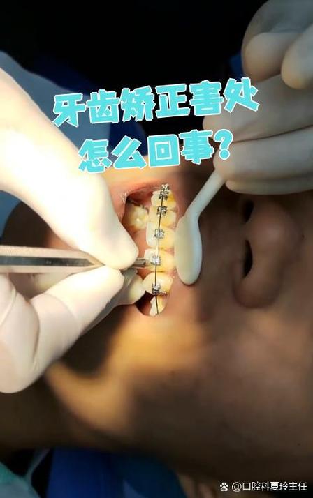 牙齿矫正发现龋齿-图2 牙齿矫正发现龋齿-图2