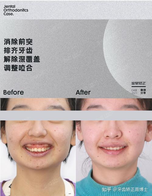 英国牙齿矫正多久-图1