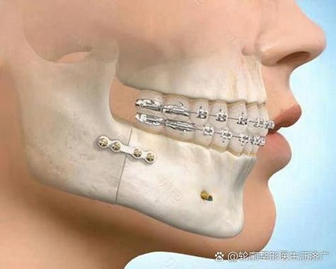 矫正牙齿 高颧骨-图2 矫正牙齿 高颧骨-图2