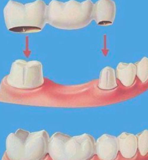 牙齿矫正能用烤瓷牙吗？效果及注意事项有哪些？-图3