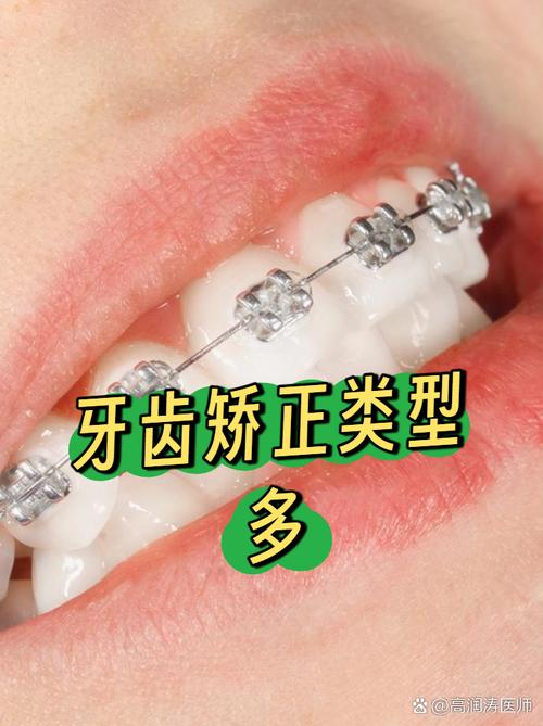 新年牙齿矫正活动有哪些优惠？-图2