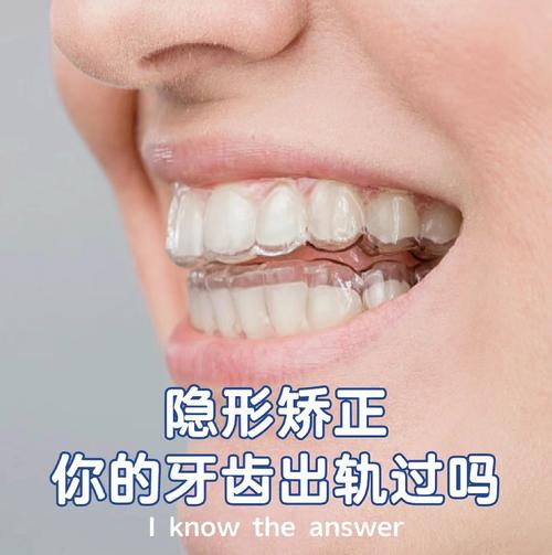 隐形矫正牙齿整形真的安全有效吗？效果能维持多久？-图1