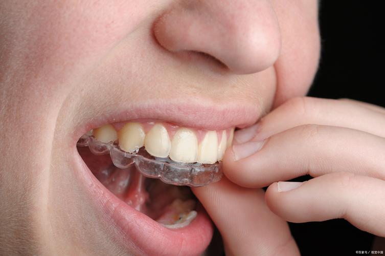 隐形矫正牙齿整形真的安全有效吗？效果能维持多久？-图2