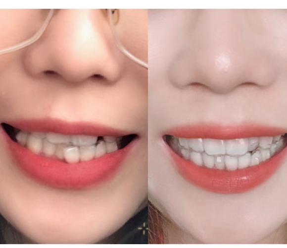 隐形矫正牙齿整形真的安全有效吗？效果能维持多久？-图3