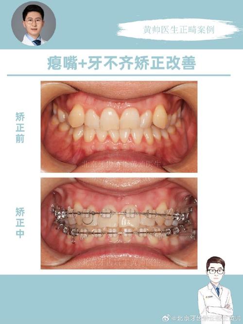 门牙内倾矫正难?原因与办法解析-图2 门牙内倾矫正难?原因与办法解析-图2