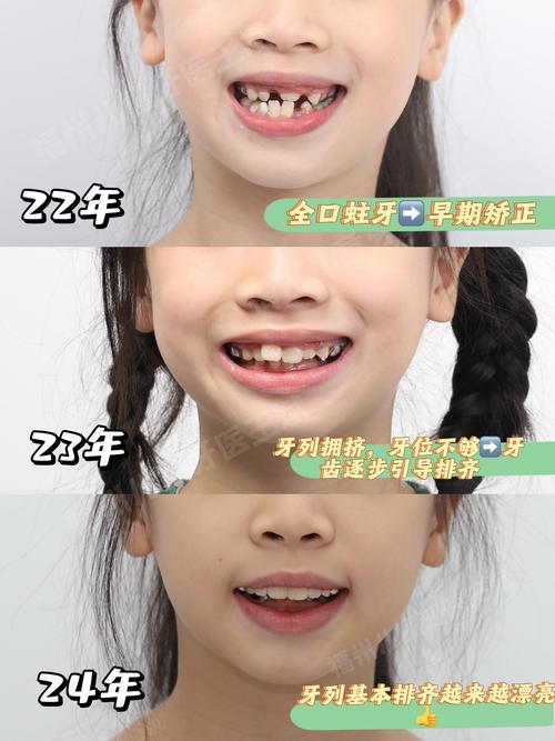 门牙内倾矫正难?原因与办法解析-图3 门牙内倾矫正难?原因与办法解析-图3