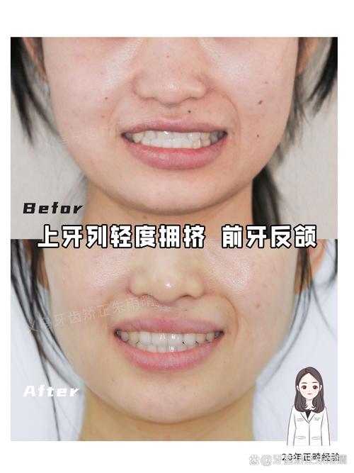 局部牙齿倾斜矫正，如何实现精准调整？-图2